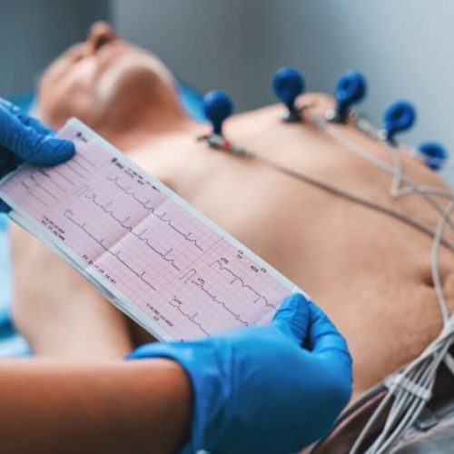 Electrocardiogram,,Ecg,In,Hand.,Cardiogram,Printout,On,Male,Patient,Background